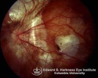 Degenerative Myopia